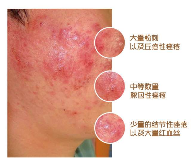 包含多吃水果对丘疹性痤疮的好处的词条