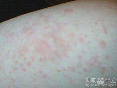 湿疹吃砂糖橘,湿疹不能吃的22种食物